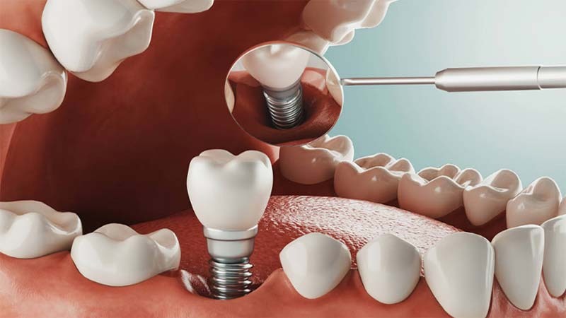 dental implant tedavisi hakkında bilgi